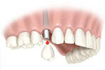 Имплантанты зубные