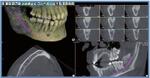 Отслеживание нервов, томограф компьютерный конусно-лучевой  WhiteFox