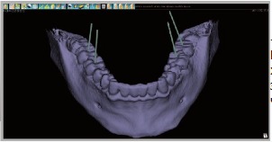 Экспорт данных в хирургическую программу, томограф компьютерный конусно-лучевой WhiteFox Экспорт данных в хирургическую программу, томограф компьютерный конусно-лучевой WhiteFox